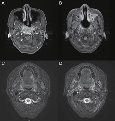 Diabetes and two kinds of primary tumors in a patient with thalassemia: a case report and literature review